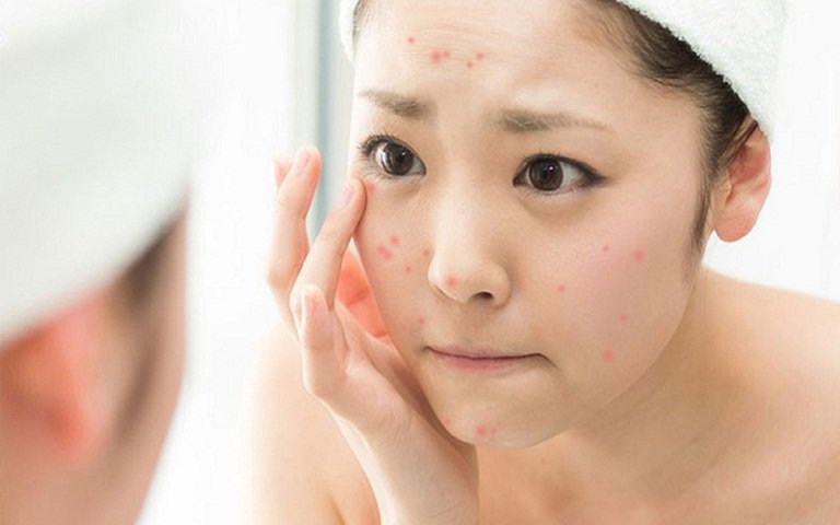 Mới nặn mụn xong nên làm gì để mụn không tái phát? | Shynh Beauty